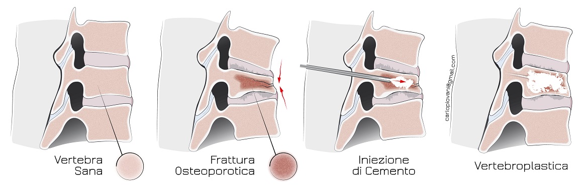 Spine Surgery | ior